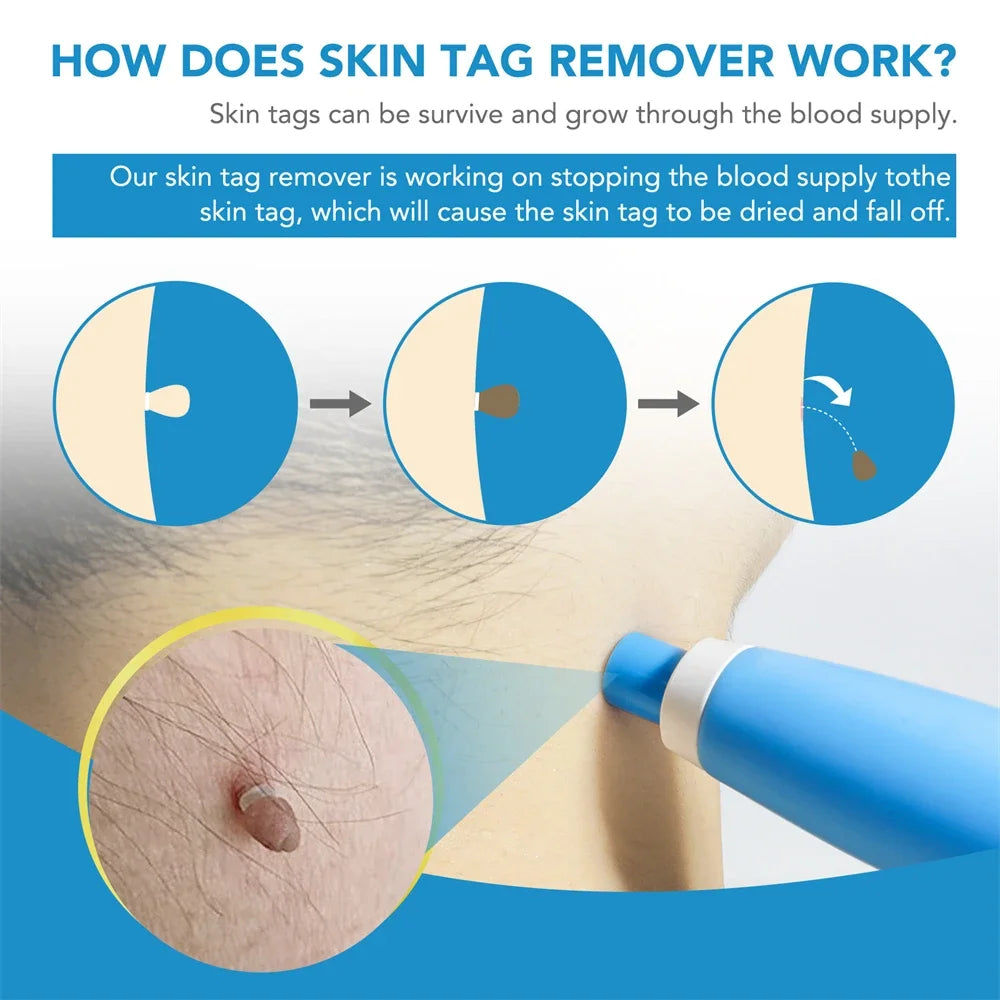 2-in-1 Auto Micro Skin Tag & Mole Remover Kit