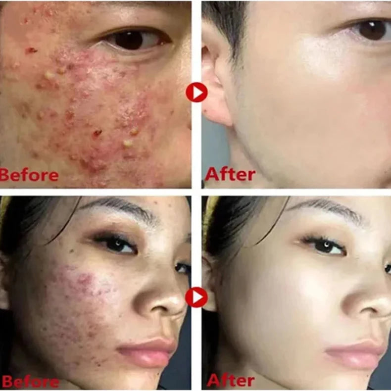 Mugwort Pore Cleansing Stick – Blackhead & Blemish Treatment