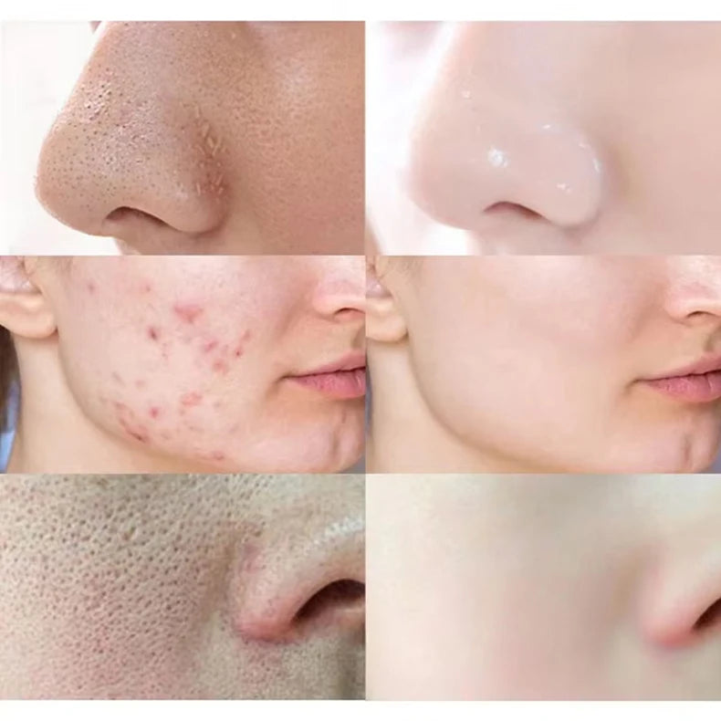 Mugwort Pore Cleansing Stick – Blackhead & Blemish Treatment